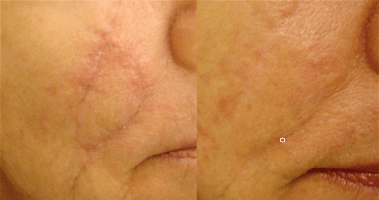 Acne Scar Treatment & Scars Reduction Philadelphia
